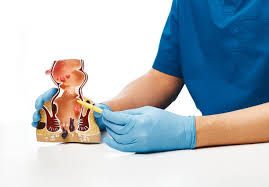 Cholecystectomy